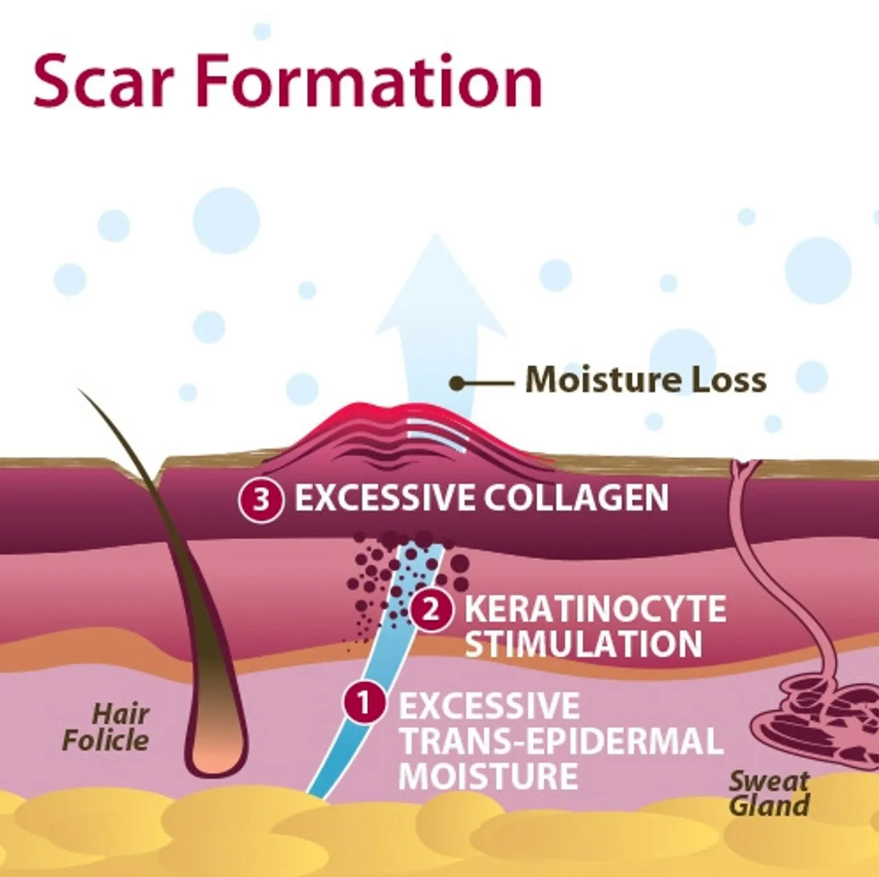 Epi-Derm Gel Mastopexy Sheet